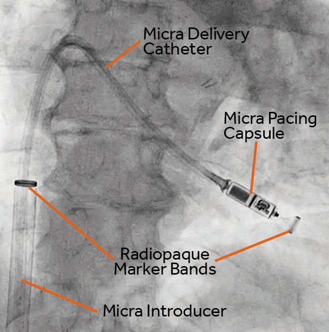 Cardiologia d’avanguardia al Fatebenefratelli di Benevento, impiantati pacemaker senza incisioni sul torace