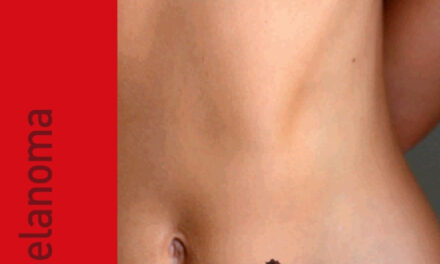 Arrivato, alla sede Lilt di Benevento un videodermatoscopio di ultima generazione